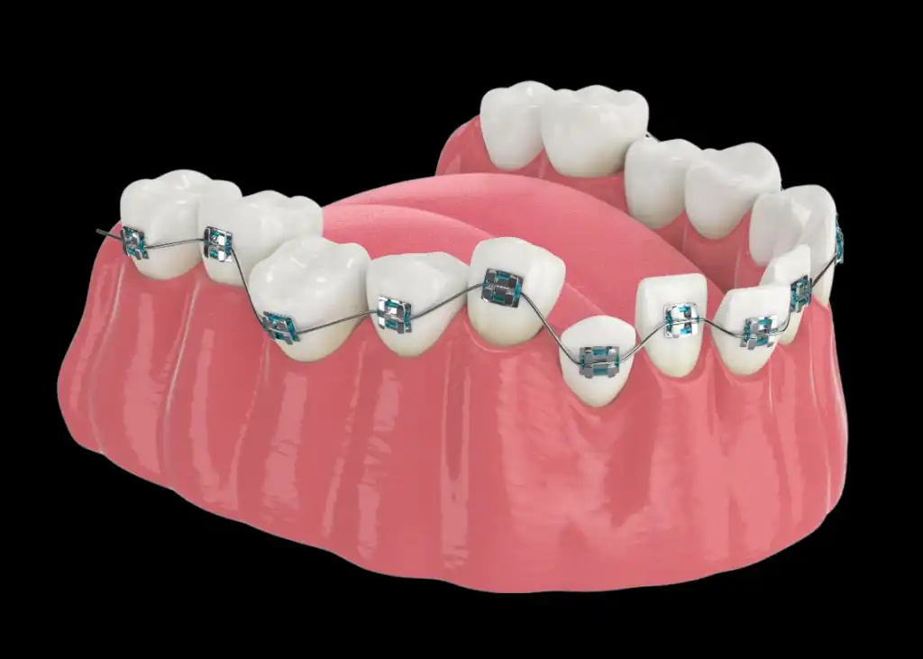 Teeth Braces