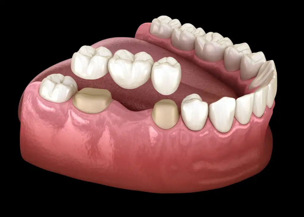 Dental Crown