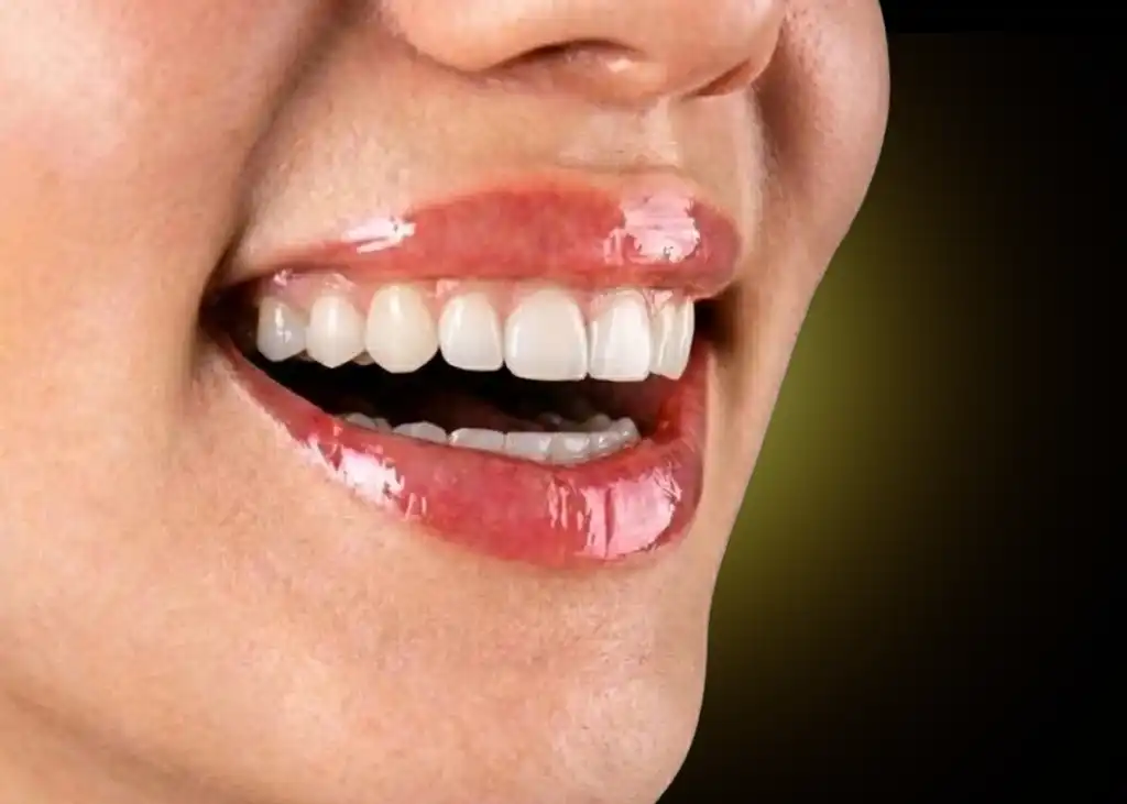 Teeth Gap Filling Result
