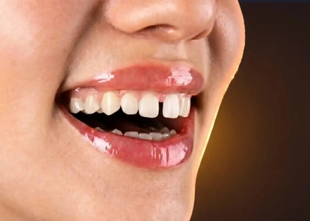 Teeth Gap Filling