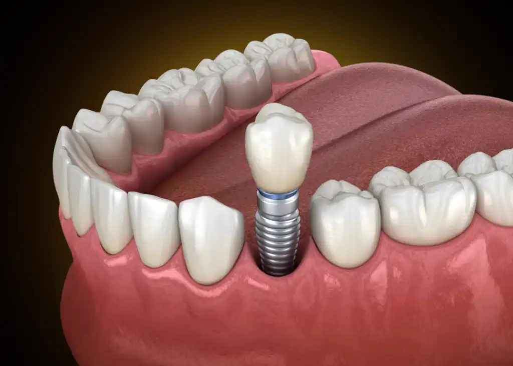 Dental Implants Permanent Tooth