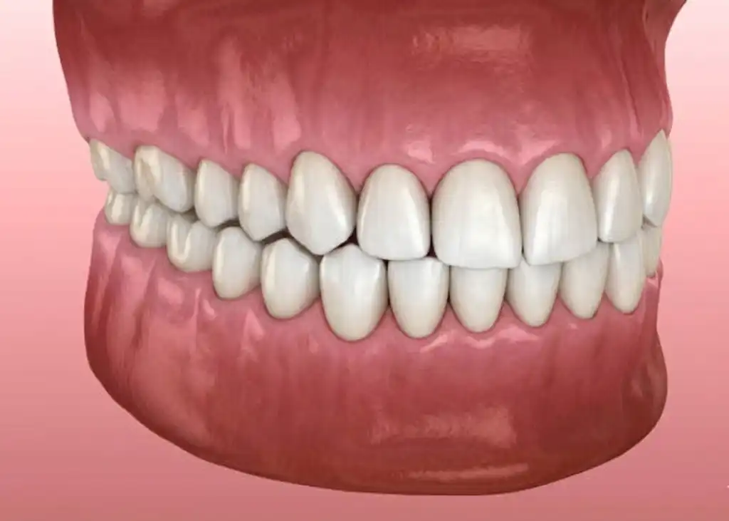 After Invisalign Clear Aligners (USA)