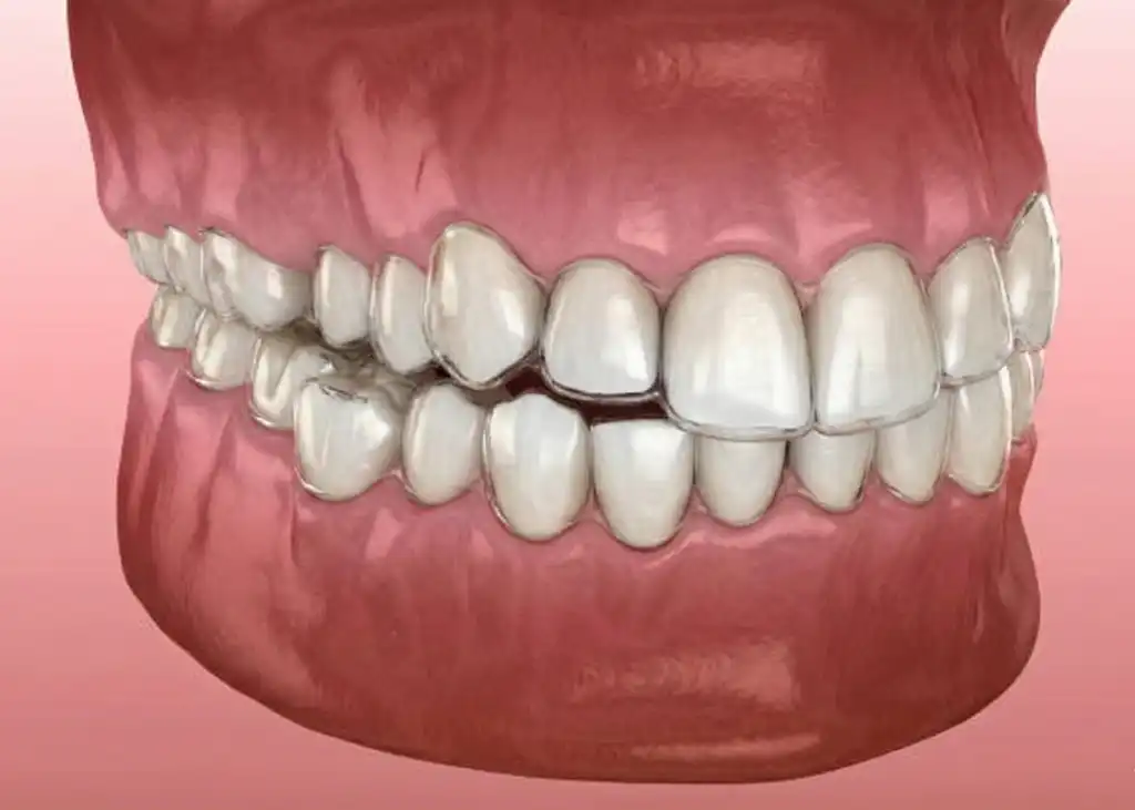 Before Invisalign Clear Aligners (USA)