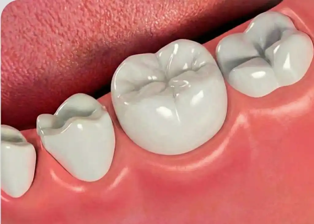 Root Canal Treatment Completed