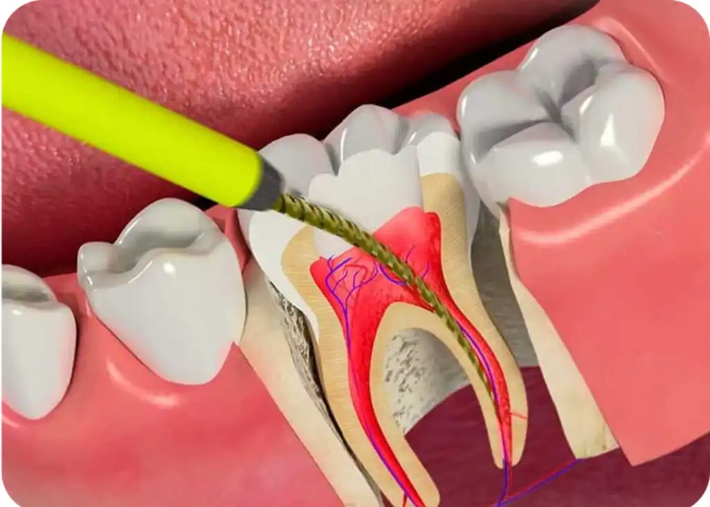 Root Canal Treatment