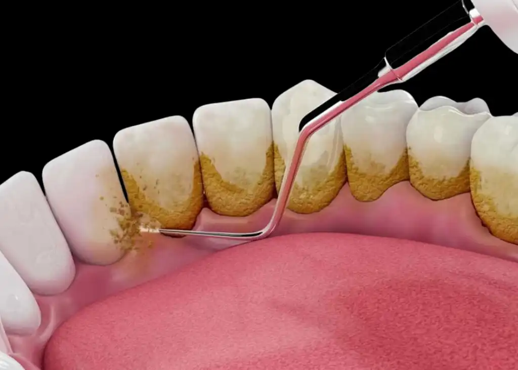 Teeth Scaling